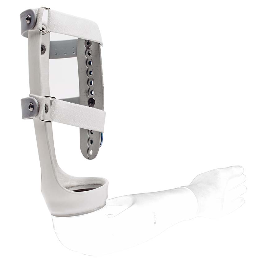 Above Elbow Socket-less Socket™ — Martin Bionics